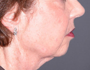 chin augmentation before photo patient